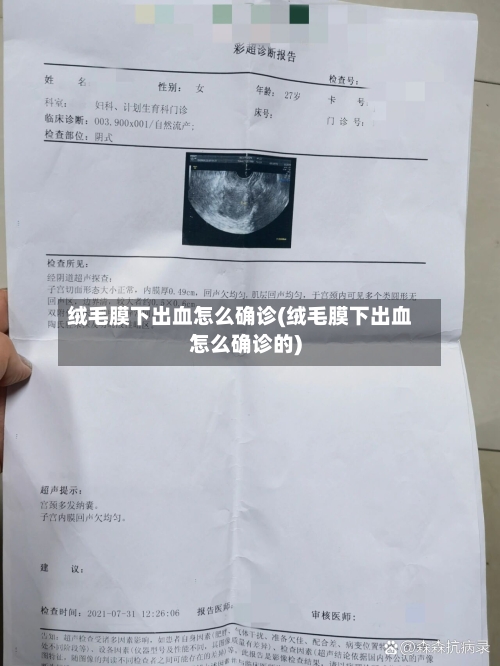绒毛膜下出血怎么确诊(绒毛膜下出血怎么确诊的)
