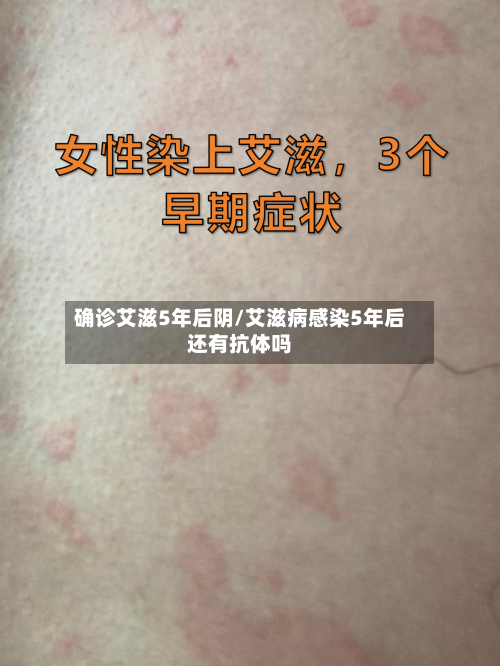 确诊艾滋5年后阴/艾滋病感染5年后还有抗体吗