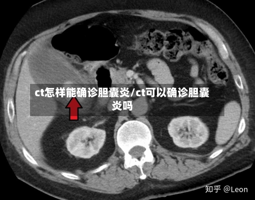 ct怎样能确诊胆囊炎/ct可以确诊胆囊炎吗